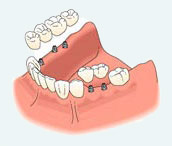 dental-implants4a