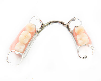 dental bridge