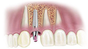 dental-implant2a