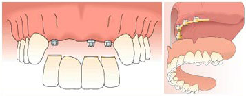 dental-implants3