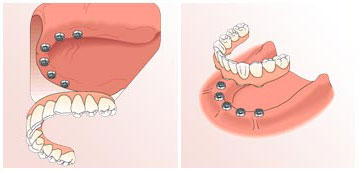 dental-implants5