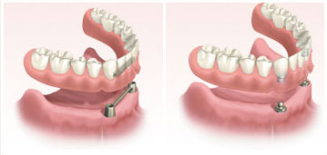 dental-implants6