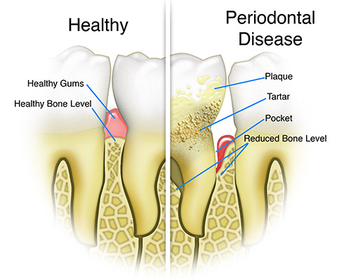 periodonic-graphic