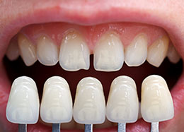 dental veneers