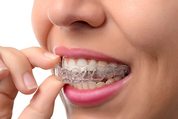 Invisaline braces