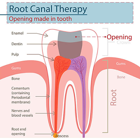 root canal diagram