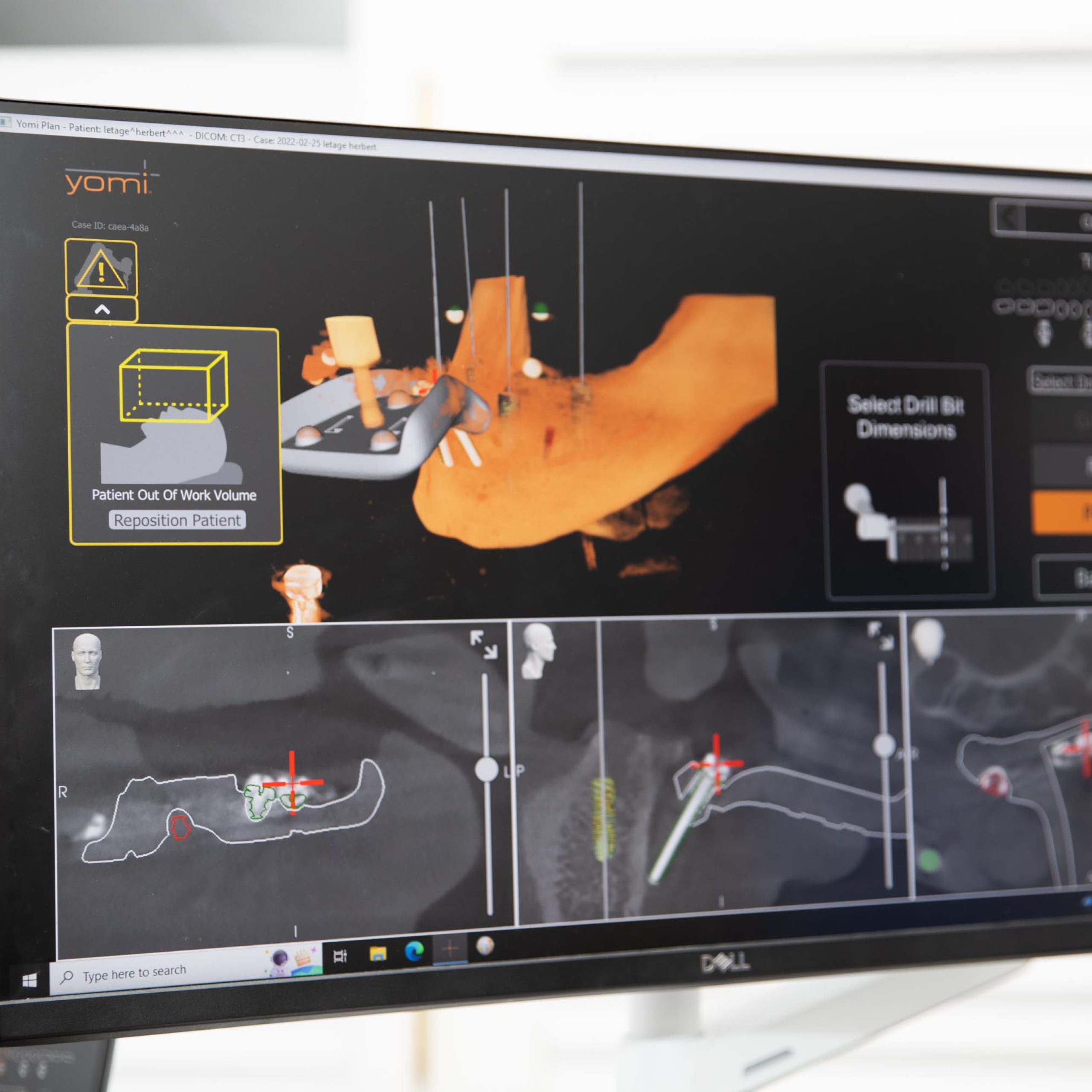 Computer screen displaying a jawbone and dental implant.